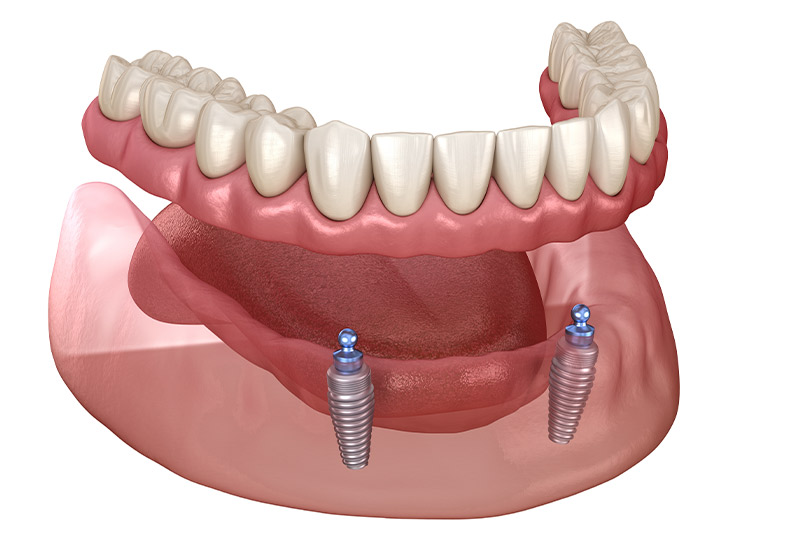 Implant supported denture
