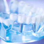 Dental clear blueish jaw model with dental tooth implant