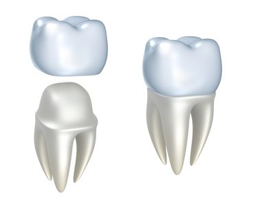3D image of how a dental crown fits over a tooth.