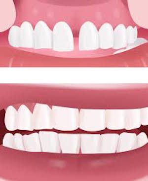 Image showing how dental bonding can fix large gaps in your teeth. 