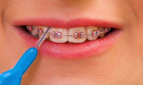 smile with braces and cleaning instrument