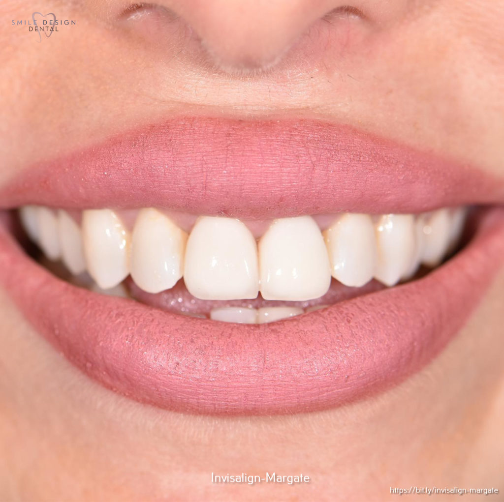 How to Get the Most Out of Your Dental Implants in Margate, FL Smile