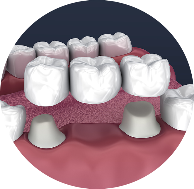 Dental bridge example model
