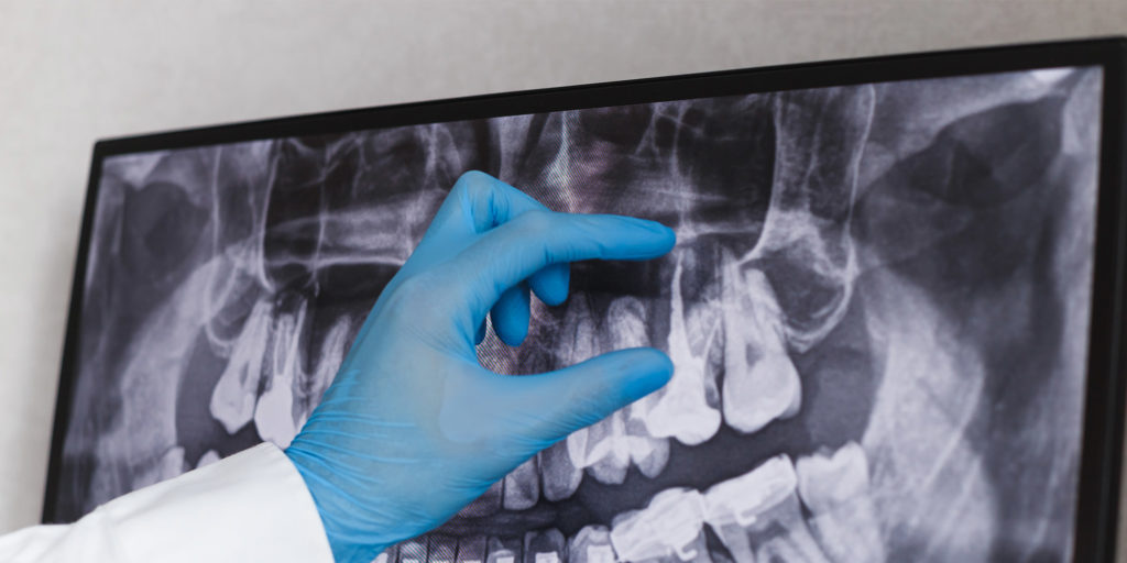 Dr. pointing to a root canal x-ray