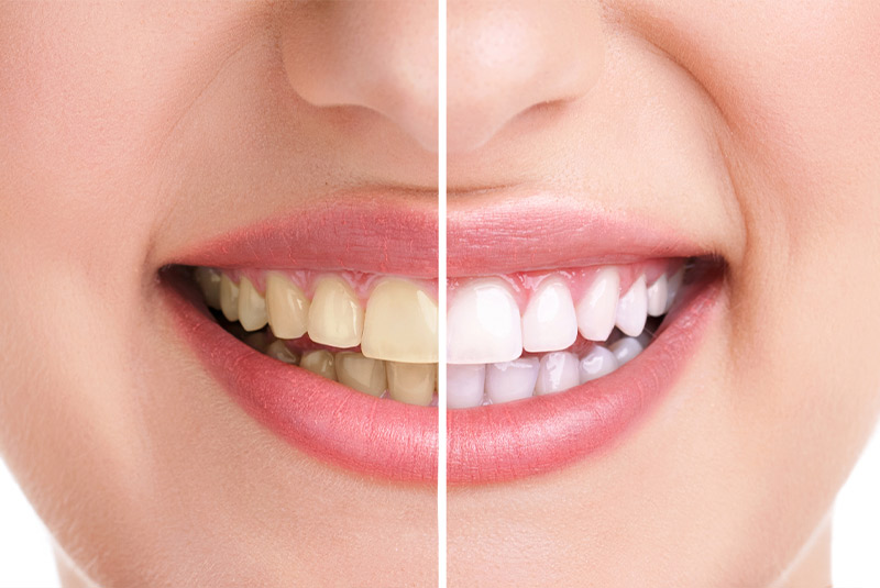 Before and after of teeth whitening