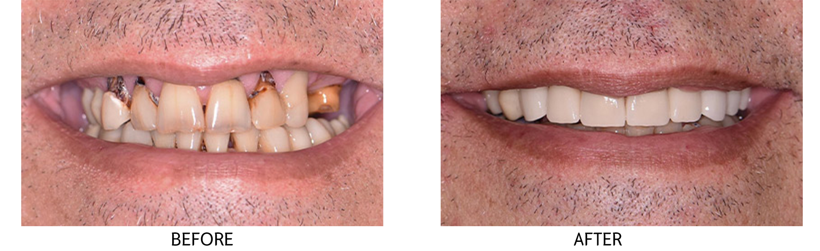 Dental Implants, Full Mouth Dental Implants, All