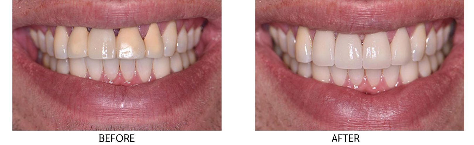 Dental Implants, Full Mouth Dental Implants, All