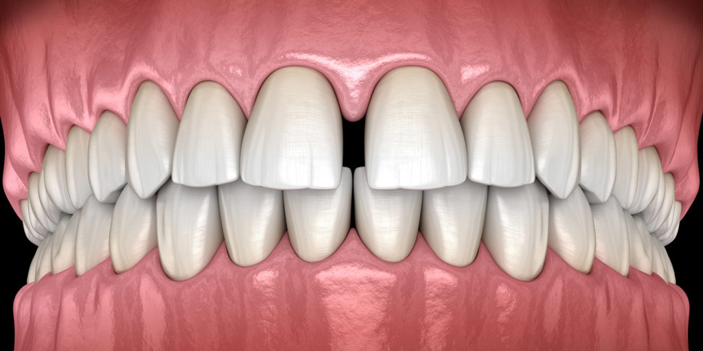 Gapped teeth example model