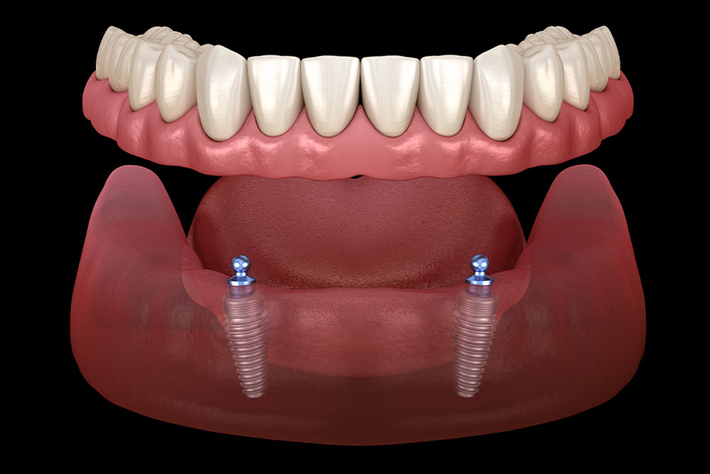 Implant supported denture example model