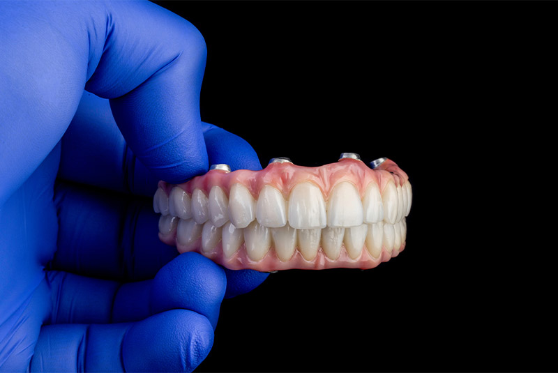 Full mouth dental implant